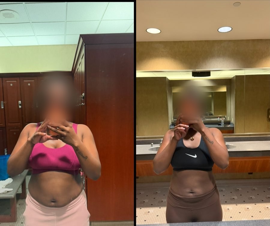 Client before and after — front view, flatter and tighter midsection